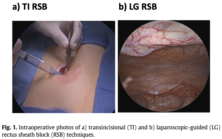 jpedsurg's tweet photo. Laparoscopic-guided versus transincisional rectus sheath block for pediatric single-incision laparoscopic cholecystectomy: A randomized controlled trial https://t.co/zg1JWjFqxm #SoMe4PedSurg #PediatricSurgery #jpedsurg #treatmentstudy #Regionalanesthesia #Cholecystectomy https://t.co/xRG36zgdJx