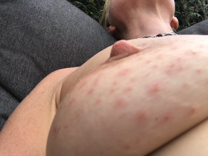 the result of a tack bra compared with lemon juice sprinkled over it. One of my favorite types of pain<a href="/tag/porn"class="tags"><span>#porn</span></a><a href="/tag/painslut"class="tags"><span>#painslut</span></a><a href="/tag/cuntbusting"class="tags"><span>#cuntbusting</span></a><a href="/tag/masochist"class="tags"><span>#masochist</span></a>