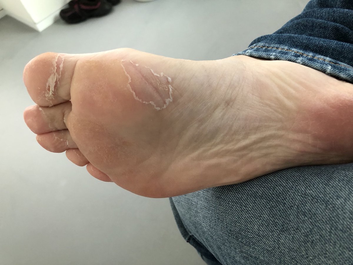 Marleentweet's tweet photo. Ja hoor, daar gaan alsnog de voetzolen langzaam.... Wat een attente donor om niet alles tegelijk aan te pakken! ☺️ #geenpijn #GvsH? https://t.co/bqUdQmkZtH