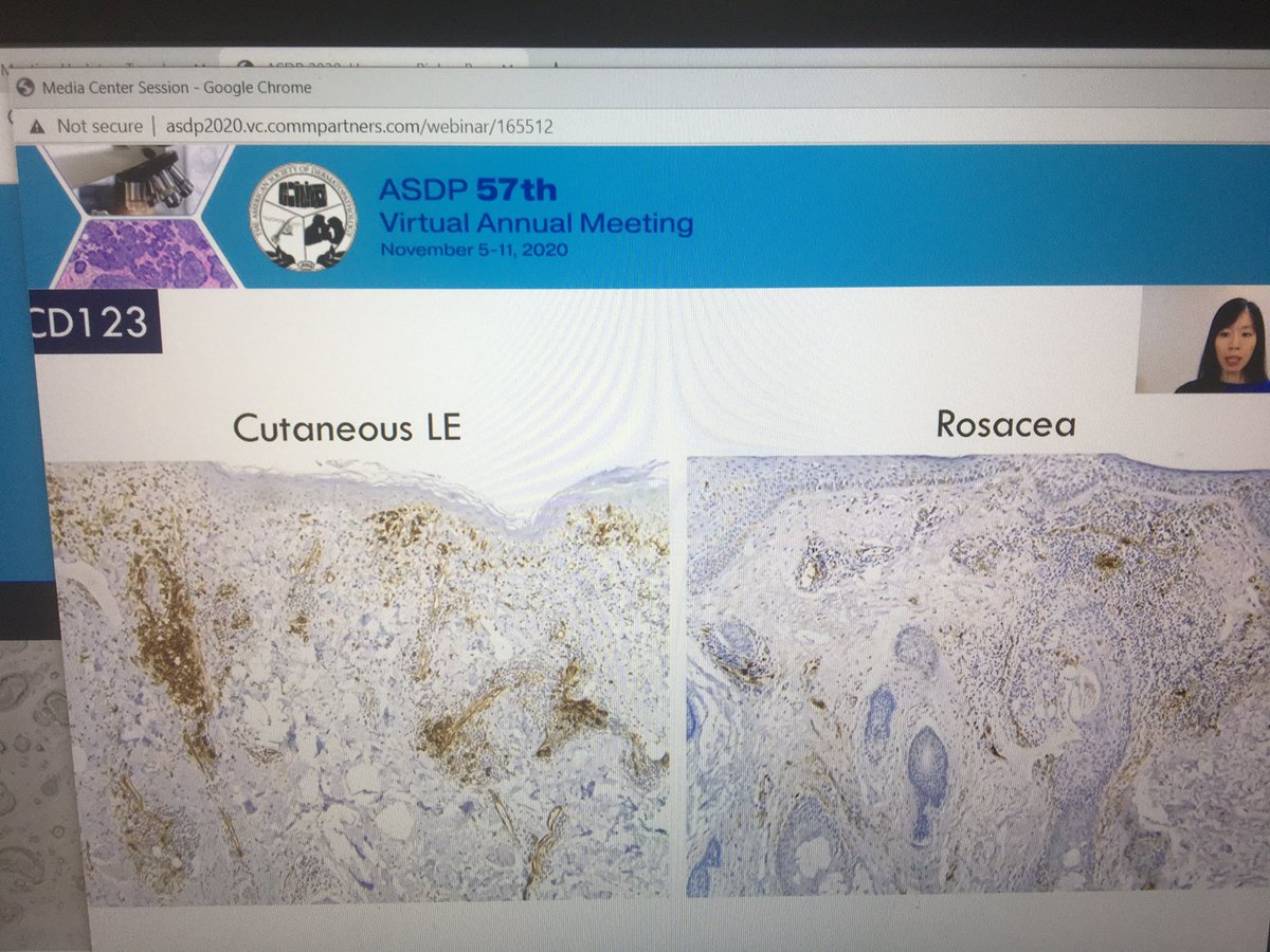 tonitatirado's tweet image. #dermpath #ASDP20 criteria when interpretation of CD123 clusters of at least 10 cells