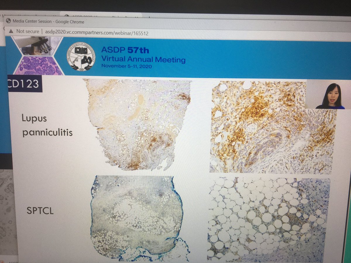 tonitatirado's tweet image. #dermpath #ASDP20 criteria when interpretation of CD123 clusters of at least 10 cells