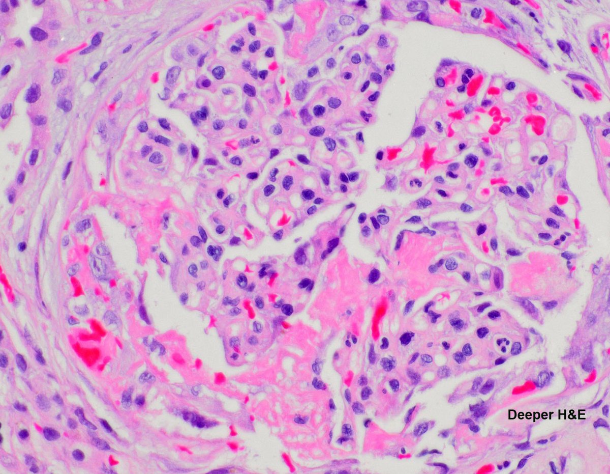 The initial sections on the biopsy of this ANCA + patient had tons of red blood cell casts. Congo red had a very suspicious lesion, but on the deeper sections everything was clear. Sometimes late results are the best ones.  #kidneypath #renalpath