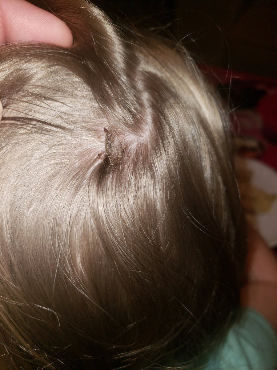 raisingGJ's tweet photo. GJ finally got her staples out today.  Now chasing her around with a torch and pitchfork just feels so...I don't know...unsatisfying. https://t.co/3hW45tc7Sl