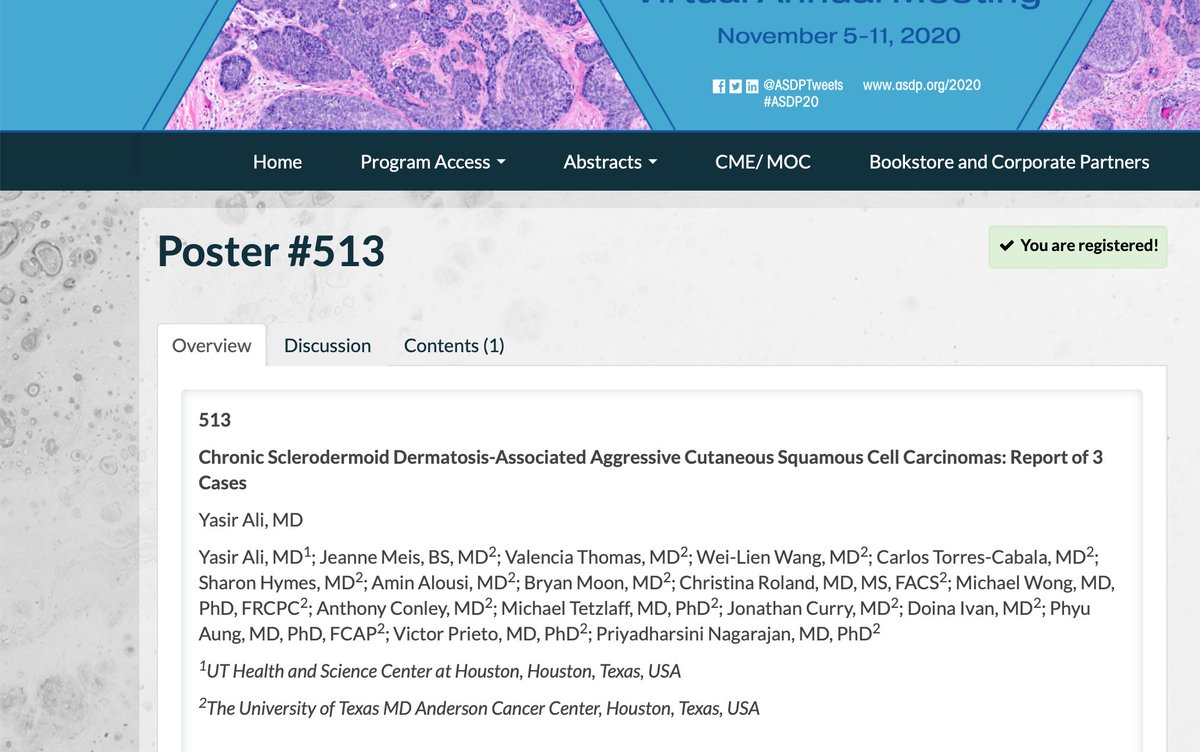 YasirAli_MD's tweet image. Come and join me today to talk about my poster "Chronic Sclerodermoid Dermatosis-Associated Aggressive Cutaneous Squamous Cell Carcinomas" and Duel abstract "Melanoma of Soft Parts with a Three-way Translocation:When a Rare Entity Becomes Even More Complicated" #ASDP2020