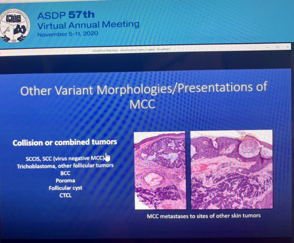 llmontaseri's tweet image. Collision and combined tumors including MCC! Also remember intraepidermal MCC! #ASDP2020 @basicsciencecourse