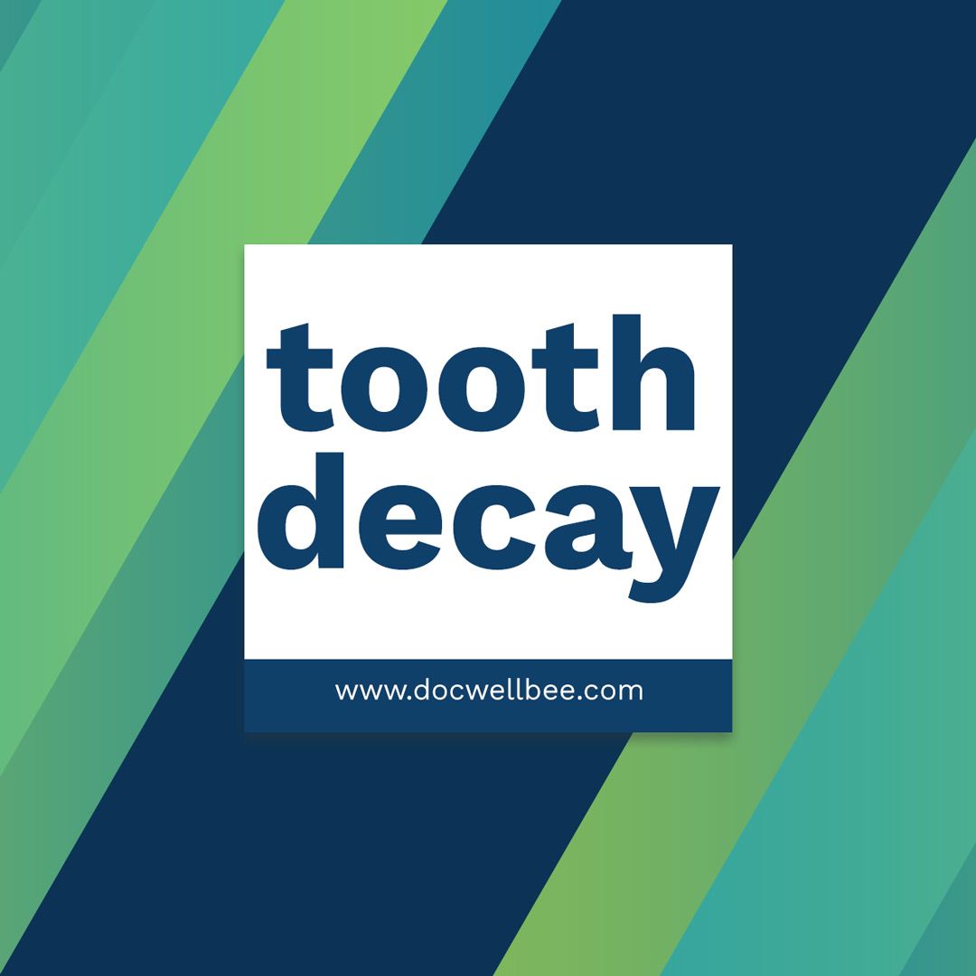 Docwellbee's tweet image. Tooth decay is damage to a tooth's surface, or enamel. It happens when bacteria in your mouth make acids that attack the enamel. If tooth decay is not treated, it can cause pain, infection, and even tooth loss.

#dentist #dentalplan #dental #health #family #mom