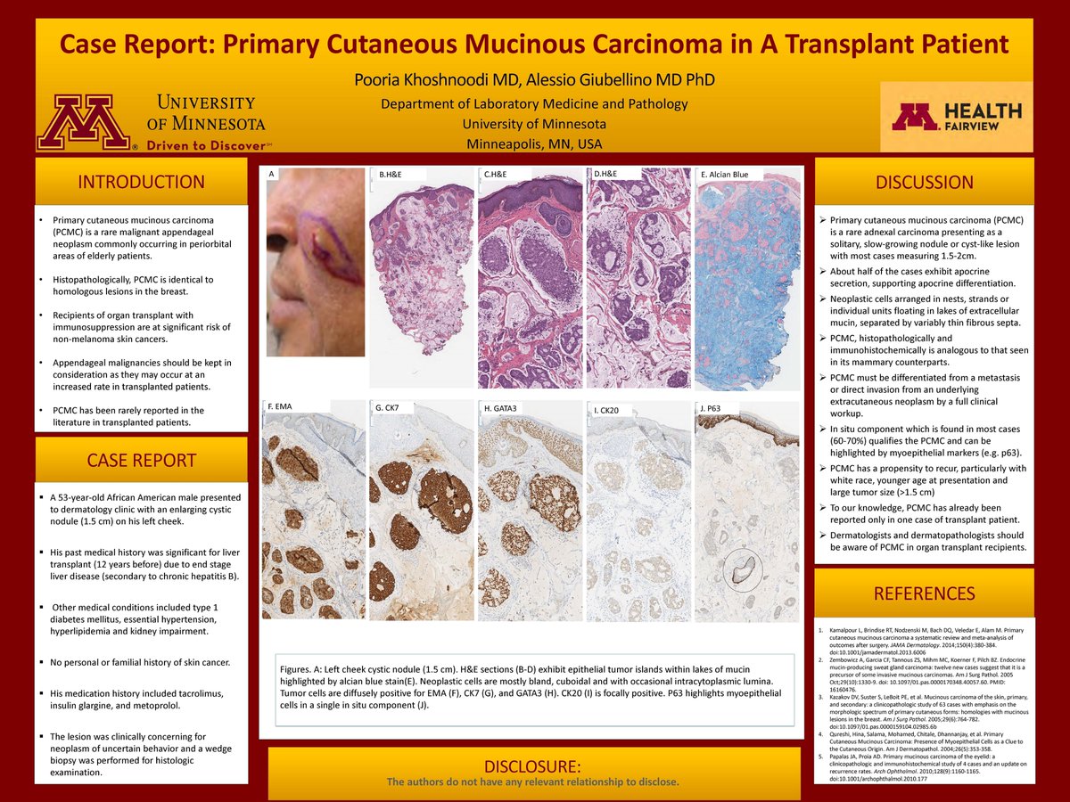 KhPooria's tweet image. "Primary Cutaneous Mucinous Carcinoma in A Transplant Patient" #ASDP20 #ASDP2020 #dermpath #dermatology