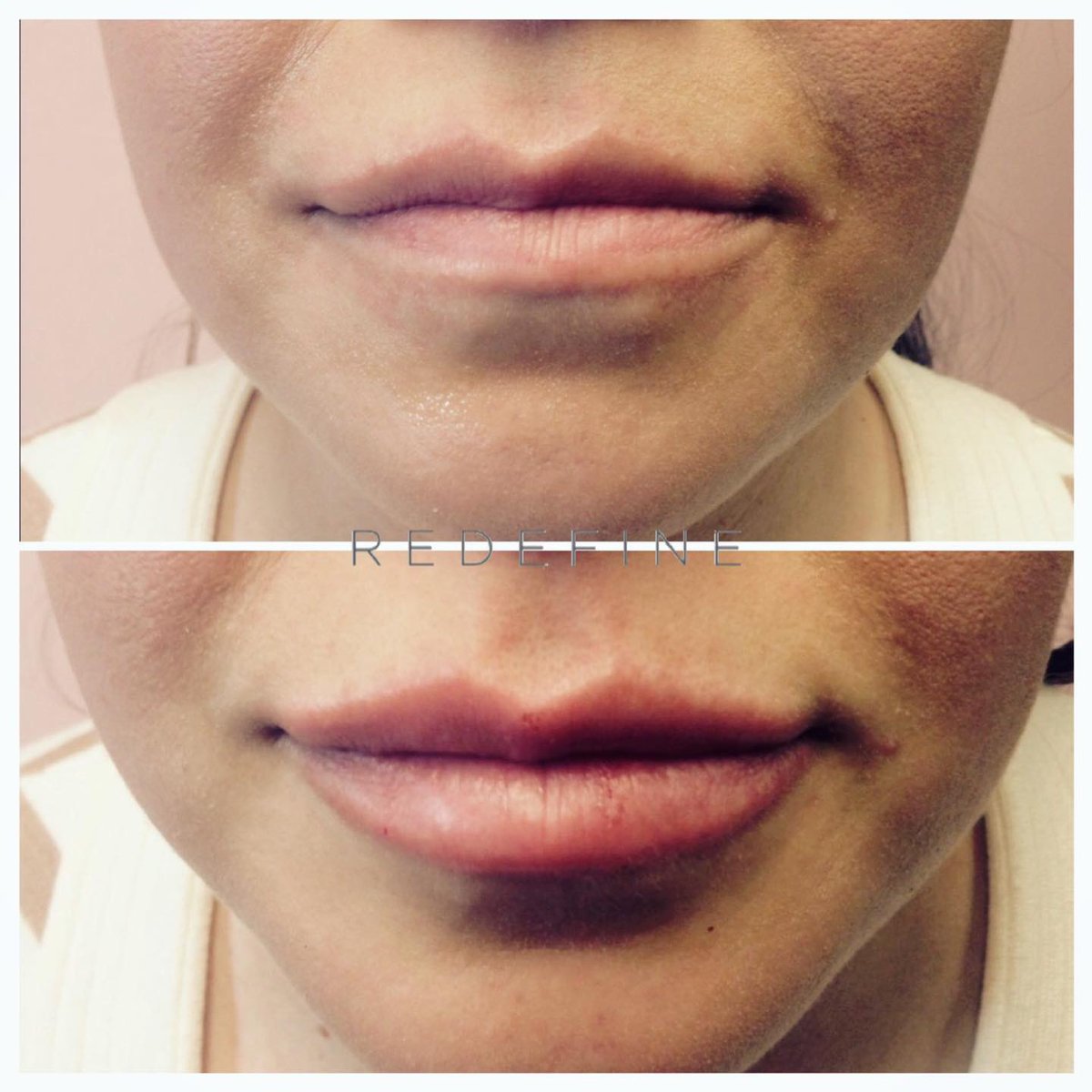 Redefine_MedSpa's tweet photo. No pouting with this great weather!

☀️ 👄 

https://t.co/x4Iz7MBviq

#RedefineMedSpa #DouglasMI #Lips #LipFillers #plumplips #naturalfillers #experiencedinjector https://t.co/21LcQpb09w