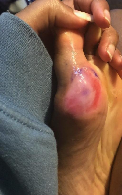 Mbowles17's tweet photo. Mentally and physically tough!!! Pitched a CG in the State Championship (1 ER, 11Ks) and beat one of the best lineups in HS softball. Her foot afterwards, not once did @jaliyah_holmes mention it. #ECTough @UGACoachTony @KarenWeekly @_TimWalton @GSAthletics_SB @AuburnSoftball https://t.co/LUJJLzsmaO