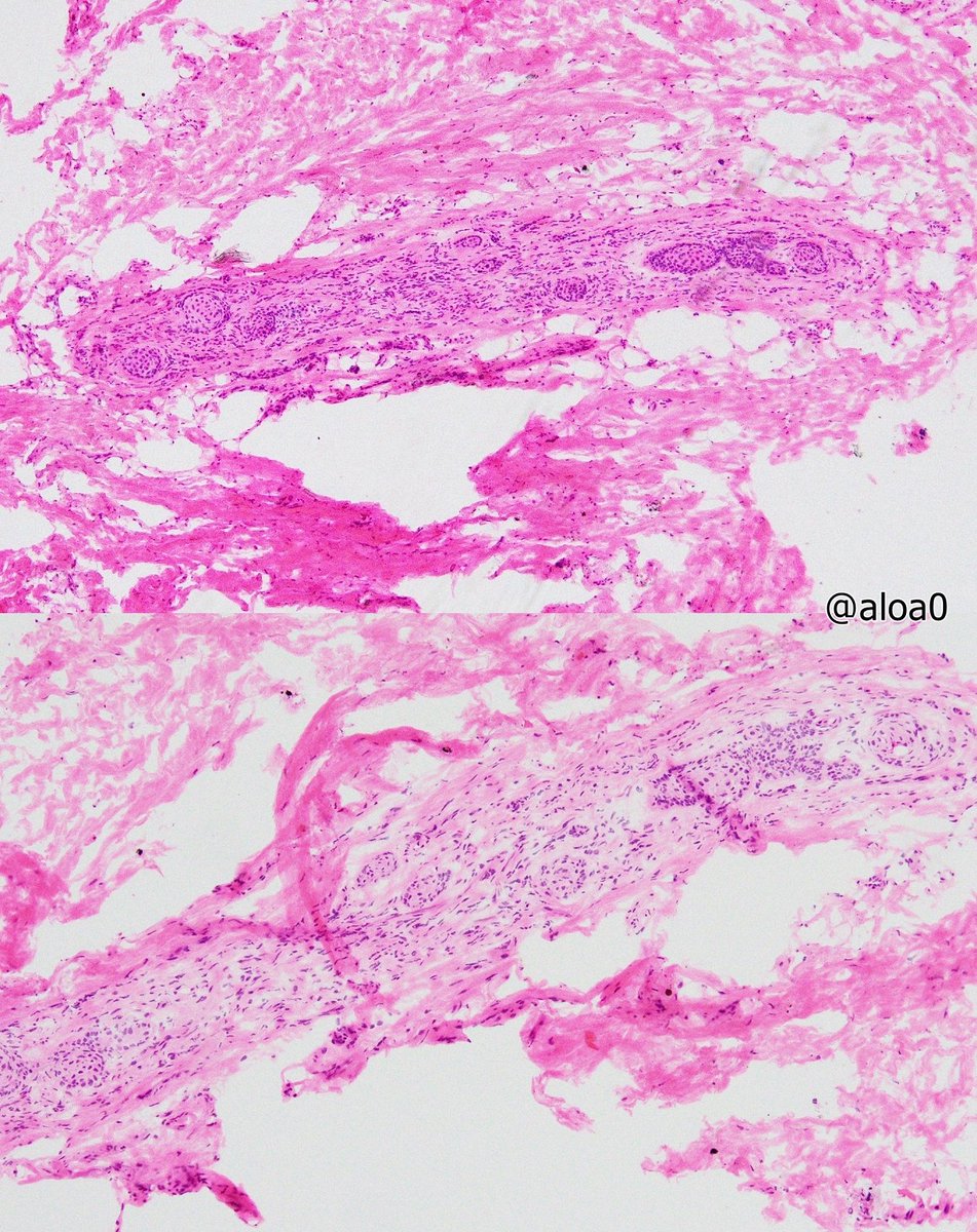 aloa0's tweet photo. Juxtaoral organ of Chievitz on frozen (pic1~3) and permanent section. #ENTpath #oralpath https://t.co/S6pU8JAupK