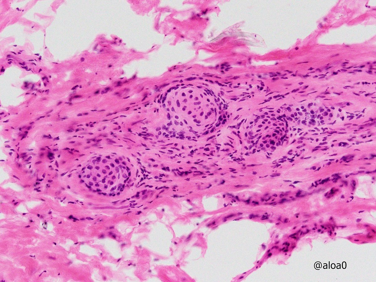 aloa0's tweet photo. Juxtaoral organ of Chievitz on frozen (pic1~3) and permanent section. #ENTpath #oralpath https://t.co/S6pU8JAupK