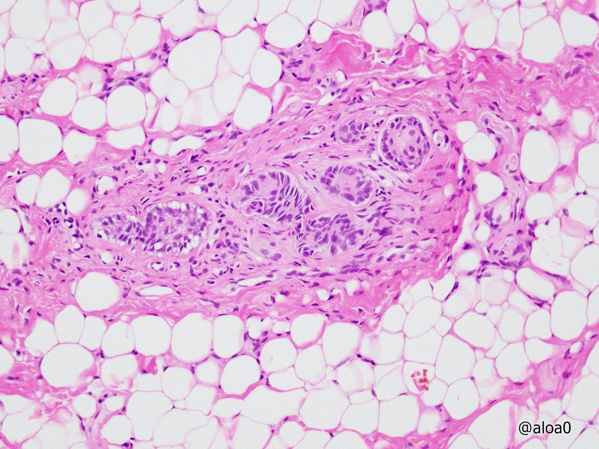 aloa0's tweet photo. Juxtaoral organ of Chievitz on frozen (pic1~3) and permanent section. #ENTpath #oralpath https://t.co/S6pU8JAupK