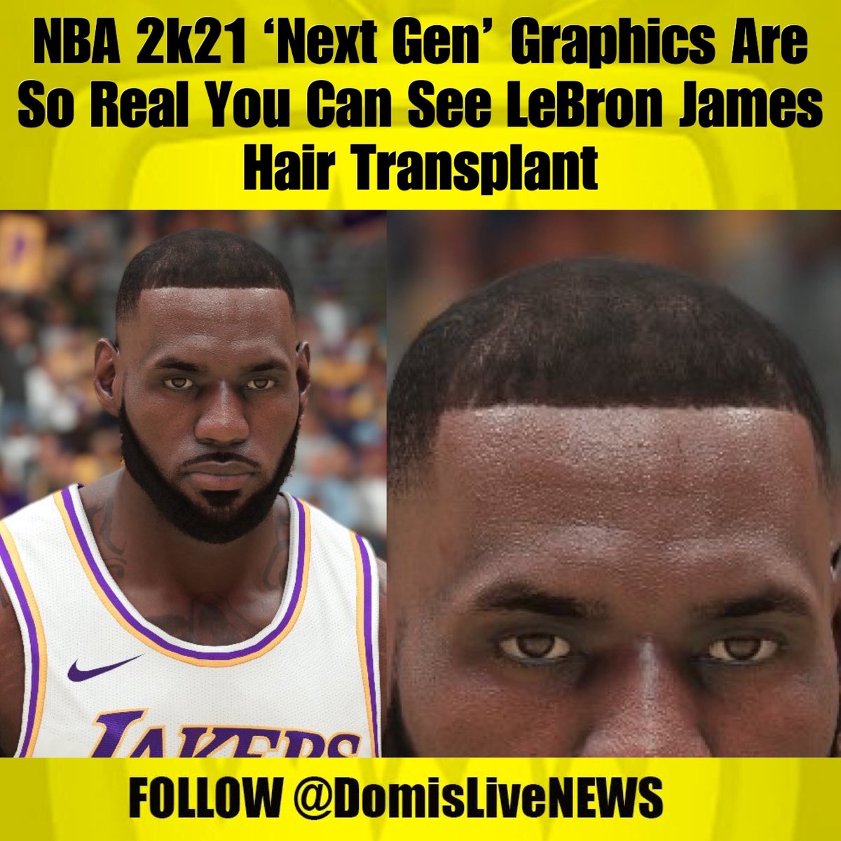 Lebron James Hair Plugs