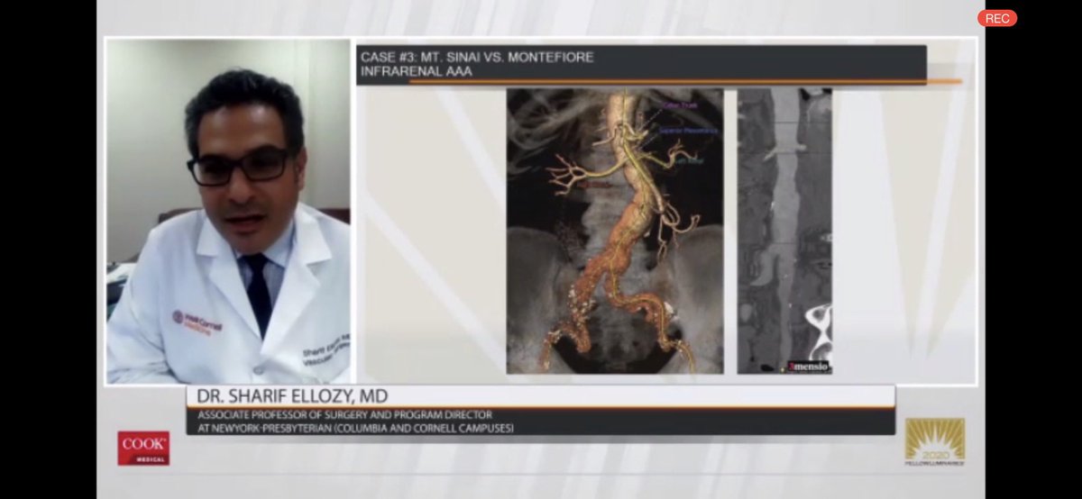 @cookvascular @StonyBrookMed @NorthwellHealth @SinaiVascular @lenoxhill Strong work from all the NY trainees on some tough aortic cases! Congratulations to all participants and those moving onto the next round. 
And when @cookvascular decides to challenge NJ, @rwjms will be ready. #jerseystrong!