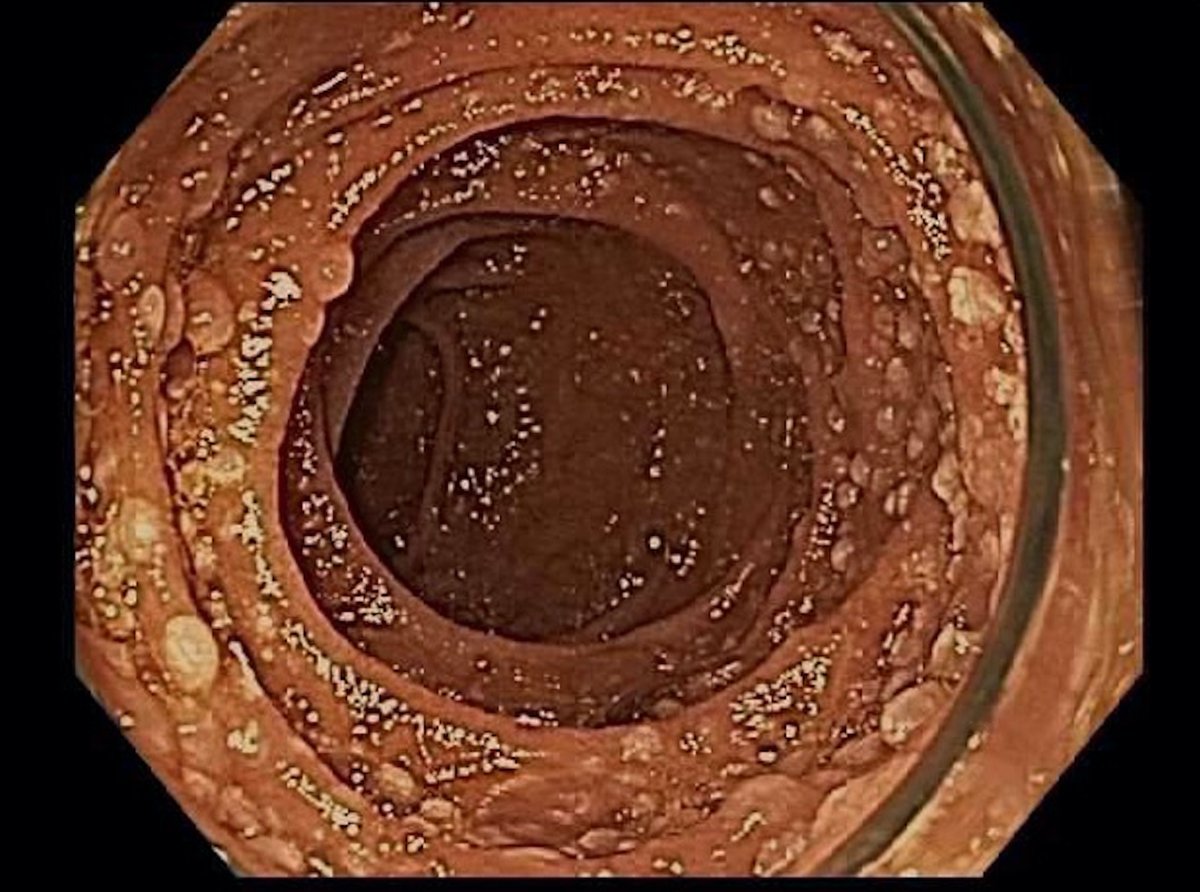 1/75-year-old female with history of BarrettEGD: Diffuse nodular mucosa in the second portion of the duodenumThoughts? Differentials? Stains and diagnosis to follow… #GIpath  #hemepath  #PathTwitter