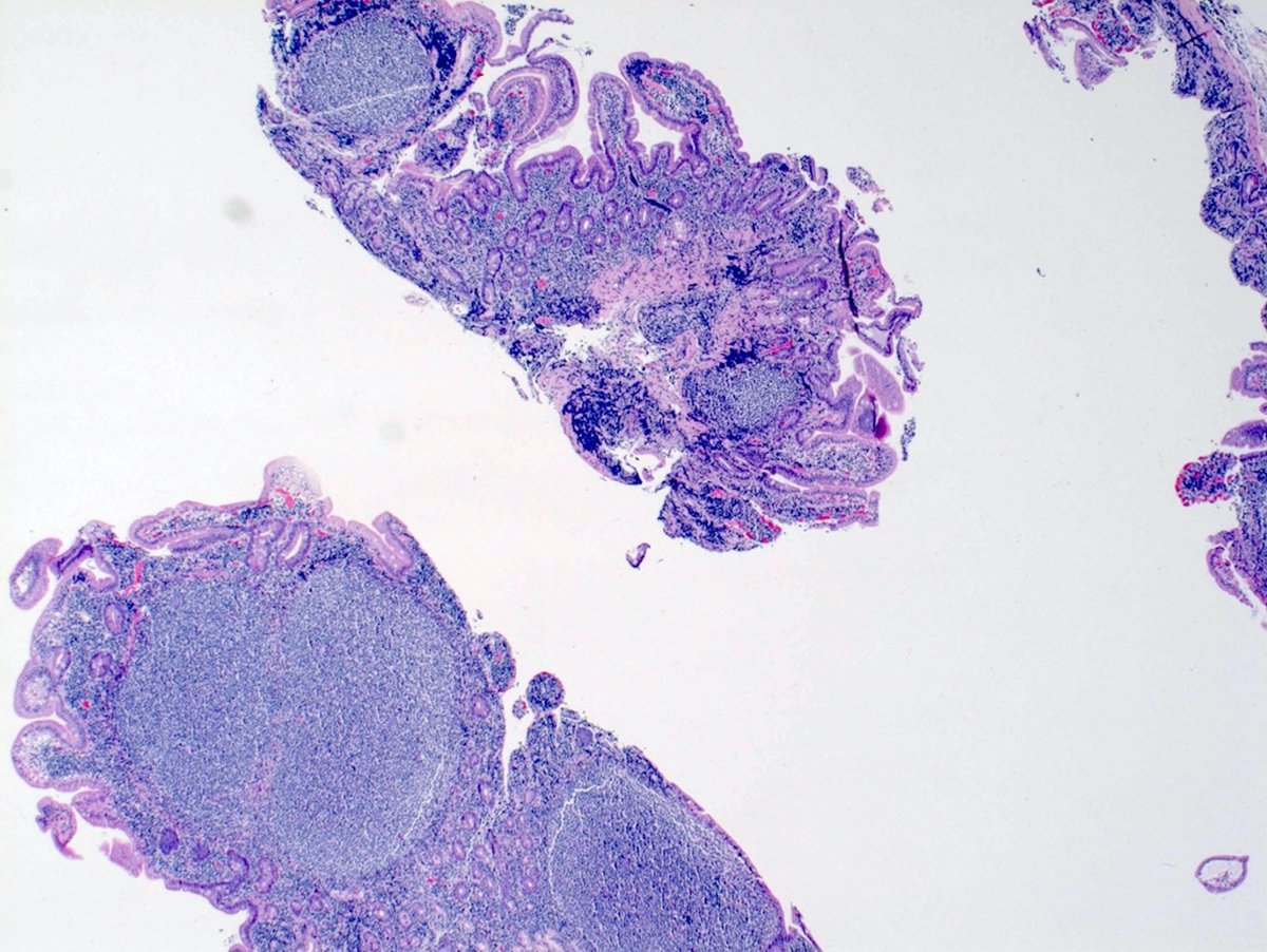 1/75-year-old female with history of BarrettEGD: Diffuse nodular mucosa in the second portion of the duodenumThoughts? Differentials? Stains and diagnosis to follow… #GIpath  #hemepath  #PathTwitter