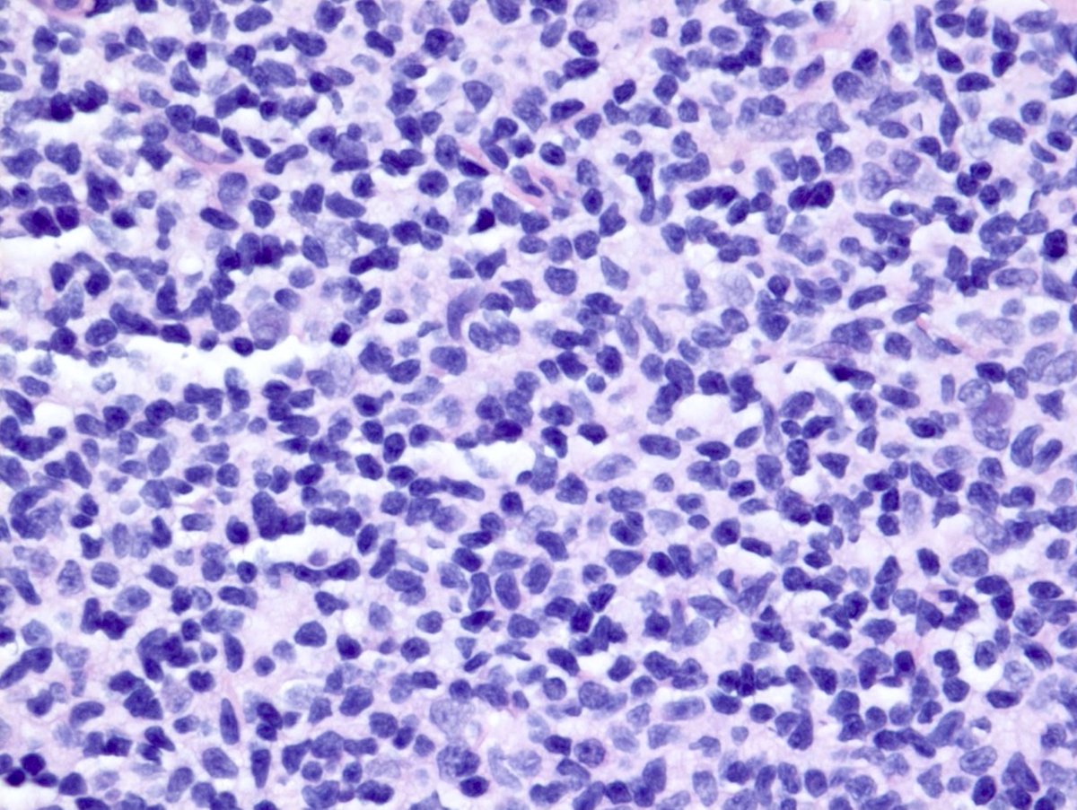 1/75-year-old female with history of BarrettEGD: Diffuse nodular mucosa in the second portion of the duodenumThoughts? Differentials? Stains and diagnosis to follow… #GIpath  #hemepath  #PathTwitter