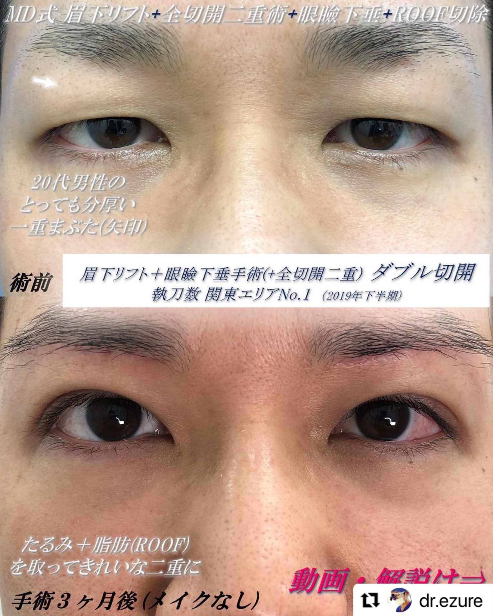 تويتر 湘南美容クリニック 赤坂見附院 على تويتر 江連院長による 若い男性の眉下切開 リフト Amp 眼瞼下垂手術 Amp 全切開二重の ダブル切開 症例です 厚いまぶたがガラッと変わって イケメンeye に 切開のいいところは なんと言っても半永久的な