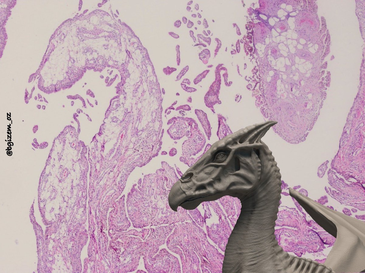 After a break i’m back with another fantastic beast #pathart in honor of #Internationalpathologyday:) 

The Thestral was my entry for the International microphotography contest. 

(Case:pigmented villonodular synovitis)

#fantasticbeastsandwheretofindthem #pathtwitter #potterhead