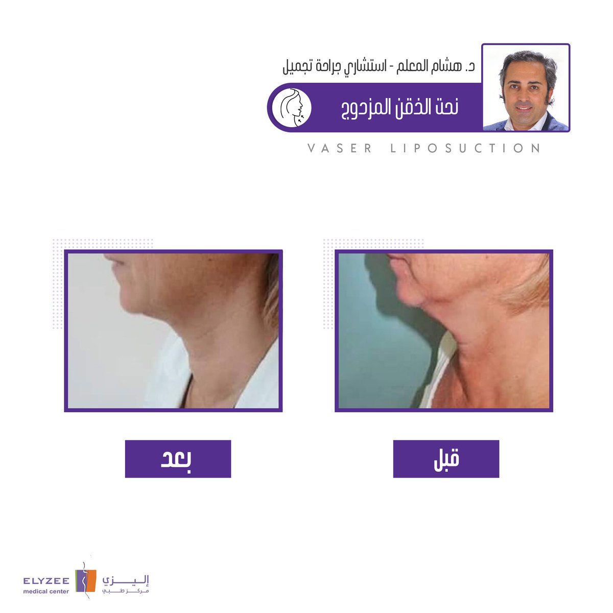 ElyzeeCenter's tweet photo. #قبل_وبعد 

حالات للدكتور #هشام_المعلم 
#نحت_الذراع
#نحت_الذقن

بتقنية 
#الفيزر

يسعدنا تواصلكم معنا للحجز والاستفسار

📩 عبر الرسائل الخاصة 

🌐 أو الحجز أونلاين عبر الموقع
رابط الحجز بالبايو

☎️ أو عبر أرقام المركز
هاتف: 0114803536
واتساب: 0507552266
الرقم الموحد: 920010934 https://t.co/Gx4pFce5a3