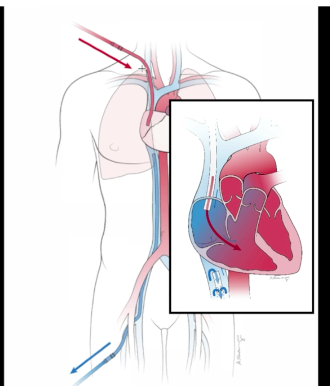 ECMO has been increasingly adopted in ARDS & critical care practice but is a complex topic to learn.These 3 videos from  @JenelleBadulak we published in  @ATSScholar are required viewing to simplify VV ECMO:1) Pt. selection & circuit tour  https://bit.ly/3lljRID&nbsp; #MedEd1/2
