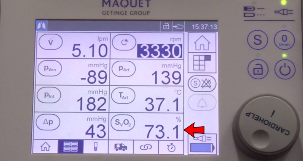 ECMO has been increasingly adopted in ARDS & critical care practice but is a complex topic to learn.These 3 videos from  @JenelleBadulak we published in  @ATSScholar are required viewing to simplify VV ECMO:1) Pt. selection & circuit tour  https://bit.ly/3lljRID&nbsp; #MedEd1/2