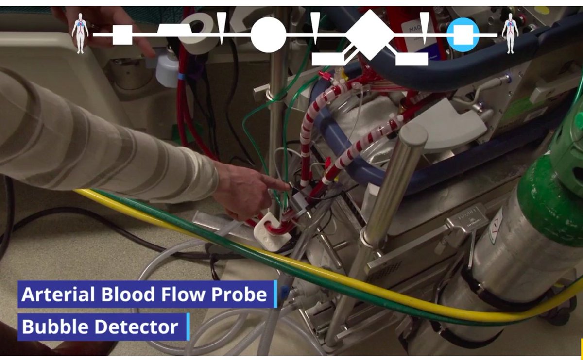 ECMO has been increasingly adopted in ARDS & critical care practice but is a complex topic to learn.These 3 videos from  @JenelleBadulak we published in  @ATSScholar are required viewing to simplify VV ECMO:1) Pt. selection & circuit tour  https://bit.ly/3lljRID&nbsp; #MedEd1/2