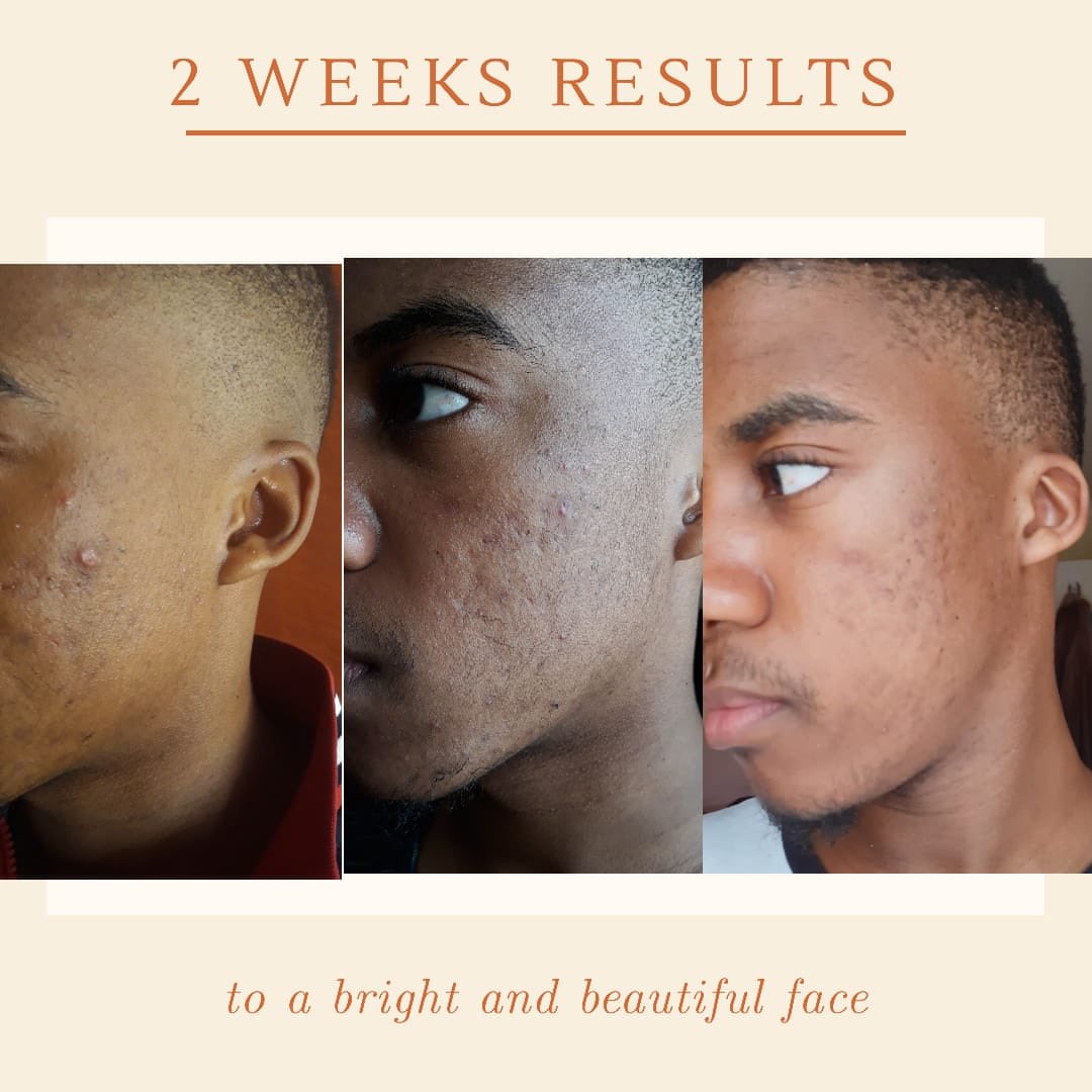 cerevita29's tweet image. Get yourself the Epoch polishing bar for an even skin tone...DM for orders 0848054874
#SoundsofFlavour
#LivingBetterStartsWith 
#ByElections 
#ICanWithAbsa 
#AceMagashule 
#my2020sexscore
Kamo Mphela