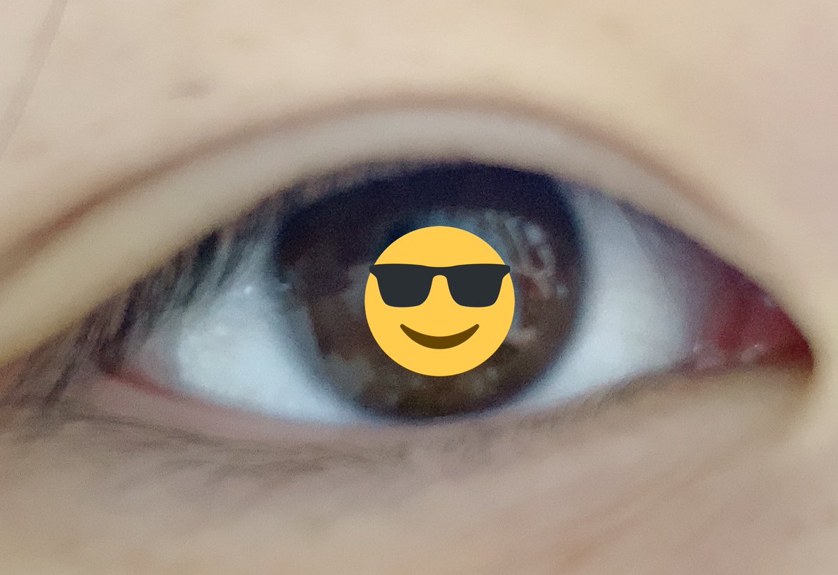 0yy02's tweet photo. 5日か6日目が経ったけれどこれは腫れじゃなくて、糸のくい込みが弱いだけなのかもしれない
まつ毛の生え際もあんまり見えてないし希望した形でもない😭😭
高いお金出したのに、、これって失敗なんじゃないんですか😭
#埋没法  #埋没失敗 #埋没経過 #埋没 https://t.co/3jVeKDXiIR