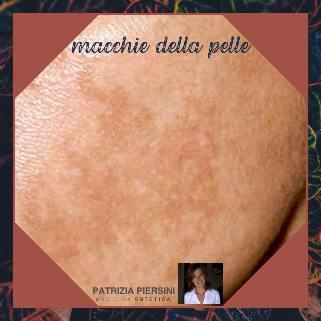 piersini's tweet image. 👙🏖️ Le #macchie della pelle sono delle alterazioni del normale colorito cutaneo. Le discromie sono dovute ad anomala pigmentazione di una parte cute, cioè da una maggiore o minore presenza di #melanina. Scopri i nostri trattamenti specifici.⁣
- - 
◗ ◗ patriziapiersini.com/macchie-pelle/
