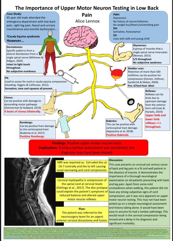 Heres <a href="/alice_lennox/">Alice Lennox</a> from @EDSRFT1 @NHS_HealthEdEng #AdvPracWeek20 poster on the importance of UMN testing in low back pain. Interesting case