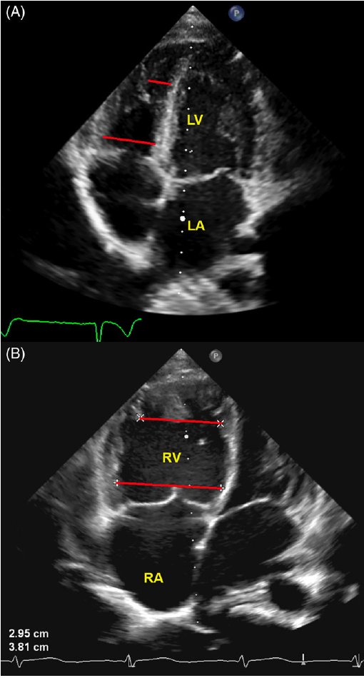 Koestenberger et al.: A decreased right ventricular end-systolic base/apex (RVES b/a) ratio (Fig B) has been shown to be associated with pediatric PAH. Fig. A shows normal RV and LV sizes.
Clin Cardiol. 2018; ncbi.nlm.nih.gov/pmc/articles/P…
km