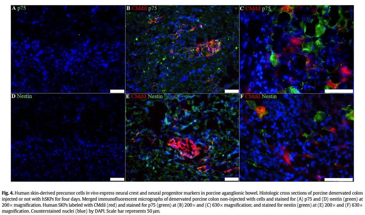 jpedsurg's tweet photo. Human skin-derived precursor cells xenografted in aganglionic bowel https://t.co/2Rj2ndSLf8 #jpedsurg #PediatricSurgery #SoMe4PedSurg #Hirschsprung #Stemcelltherapy #Neuralcrestcells #Intestinalaganglionosis https://t.co/AavhDL9acx