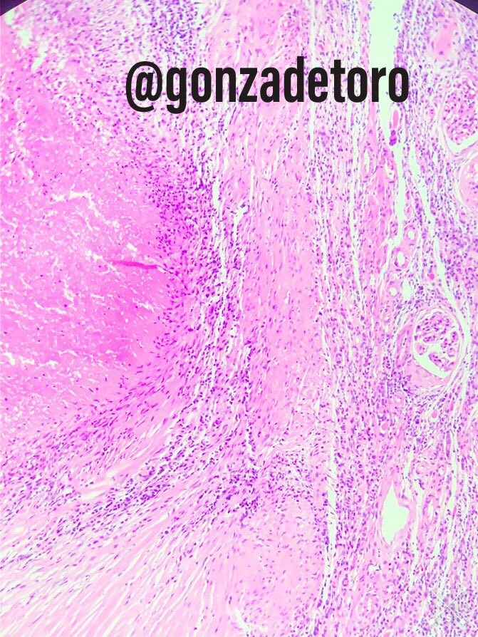 49yo Male #uropath #urology #urologia #bugspath #gupath #pathology #grossnosis #grosspath @JMGardnerMD @loyolapathology @IntSocUropath @GU_Path_Society