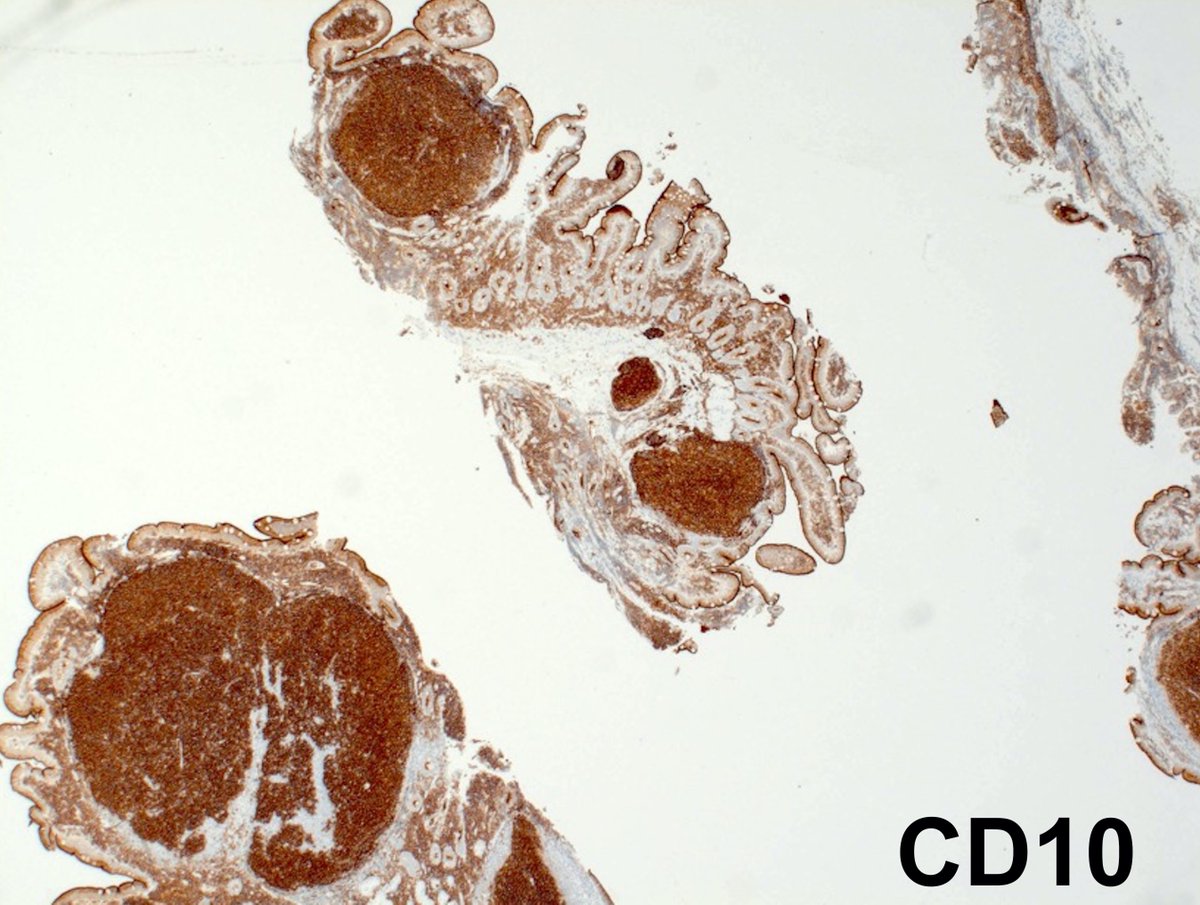 2/5 Diagnosis: Duodenal Type Follicular Lymphoma-Well-defined WHO entity-Specific variant of FL with distinctive clinical and biological features- Predominantly small intestine - duodenum (80-85% of cases); esp. second portion of duodenum #GIpath  #hemepath  #PathTwitter