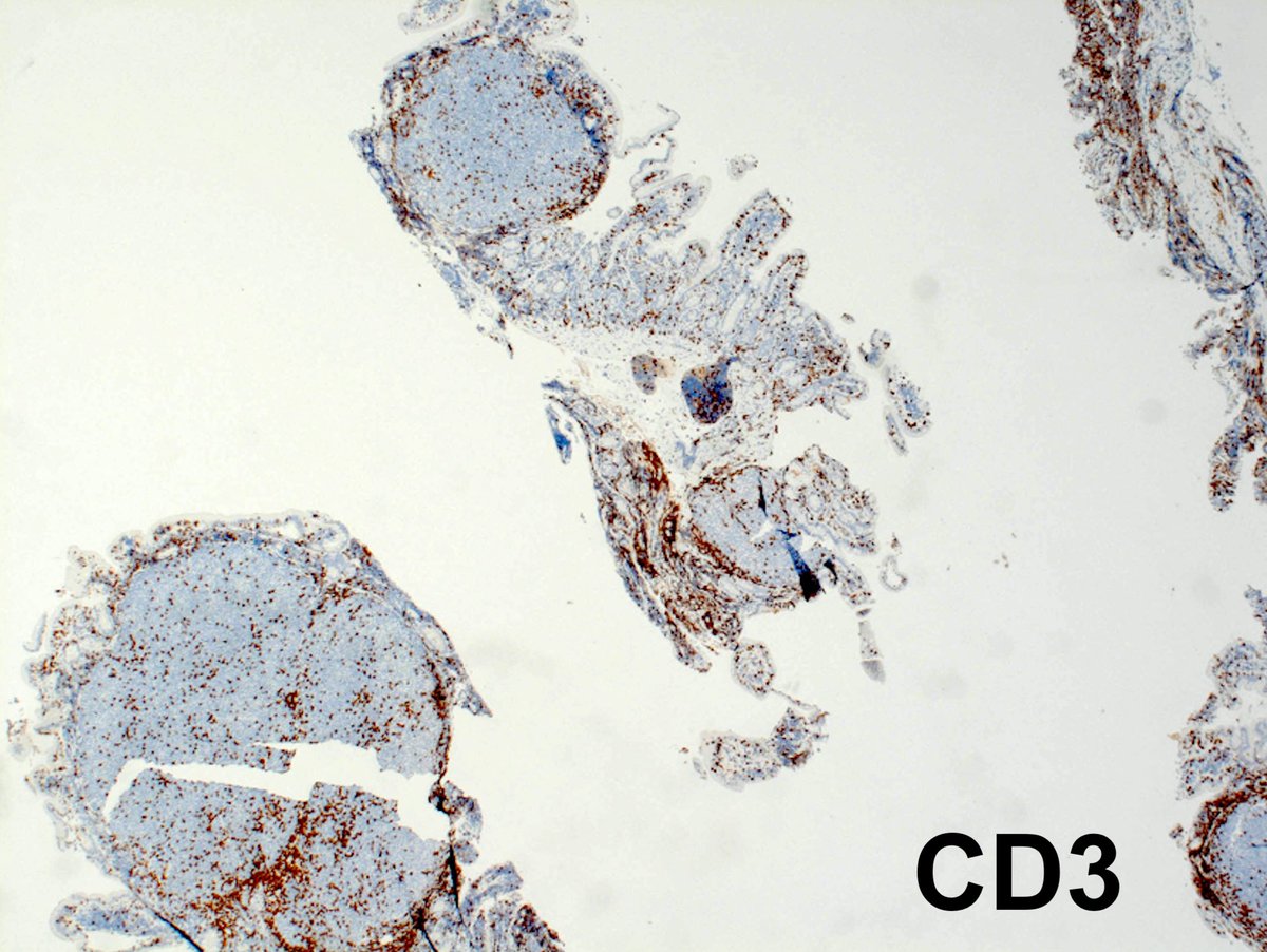 2/5 Diagnosis: Duodenal Type Follicular Lymphoma-Well-defined WHO entity-Specific variant of FL with distinctive clinical and biological features- Predominantly small intestine - duodenum (80-85% of cases); esp. second portion of duodenum #GIpath  #hemepath  #PathTwitter