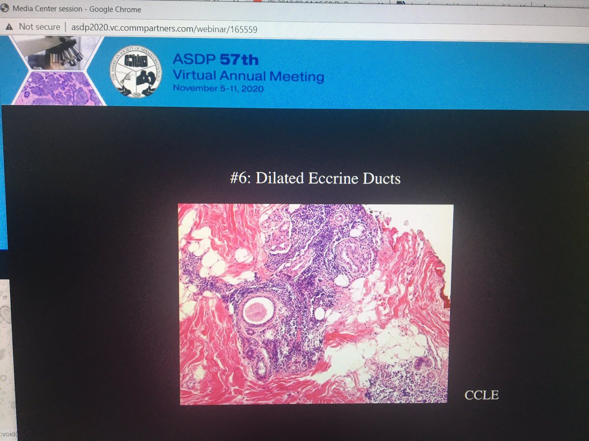 tonitatirado's tweet image. #dermpath #ASDP20 How to know you have a cicatricial alopecia 1