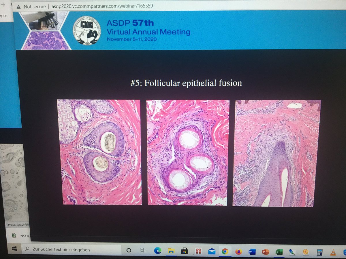 tonitatirado's tweet image. #dermpath #ASDP20 How to know you have a cicatricial alopecia 1