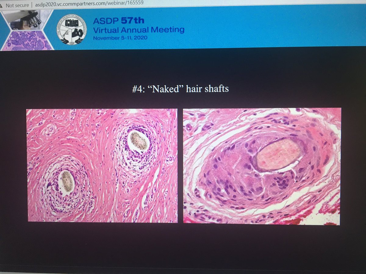 tonitatirado's tweet image. #dermpath #ASDP20 How to know you have a cicatricial alopecia 1