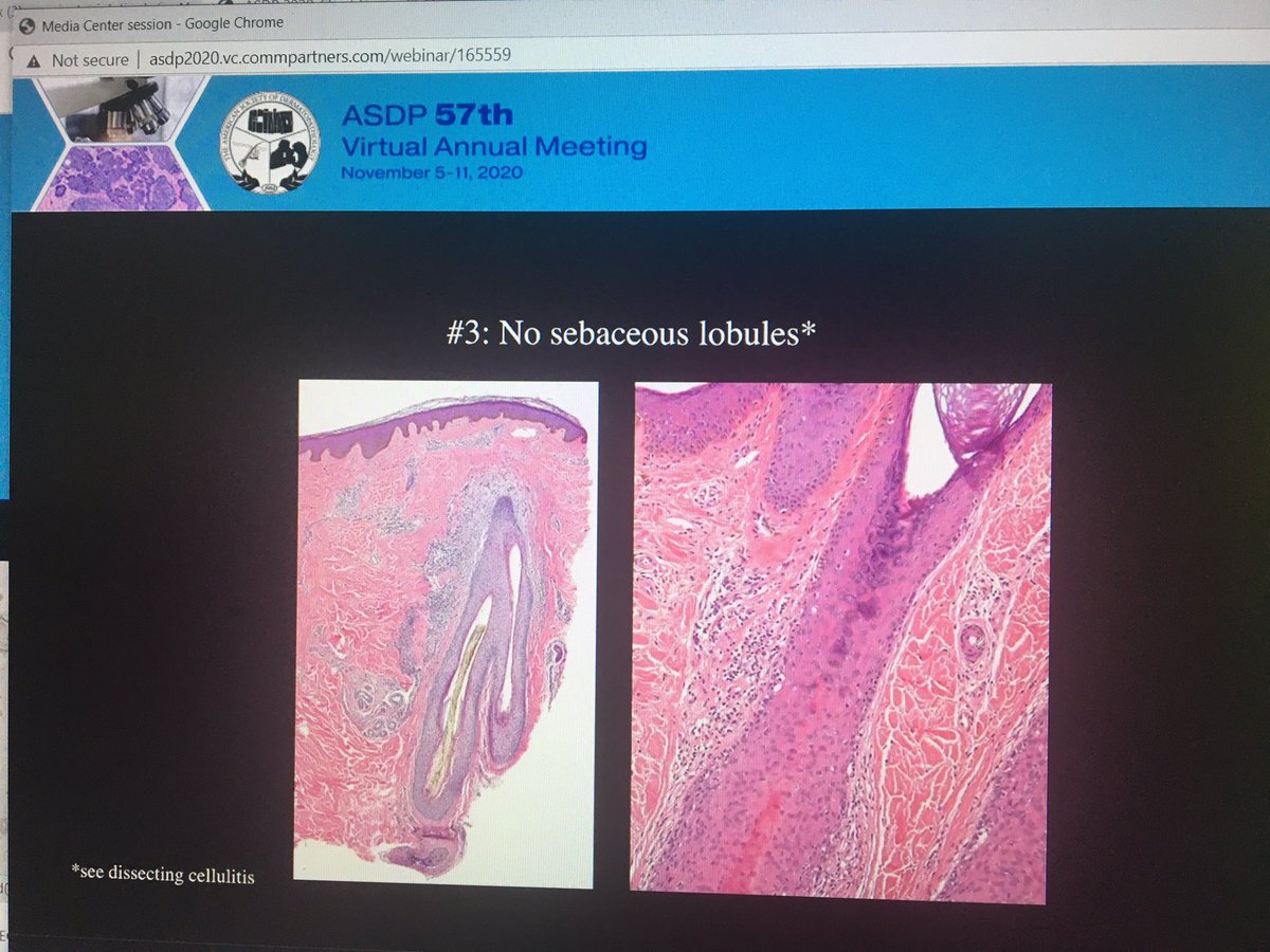 tonitatirado's tweet image. #dermpath #ASDP20 How to know you have a cicatricial alopecia 2