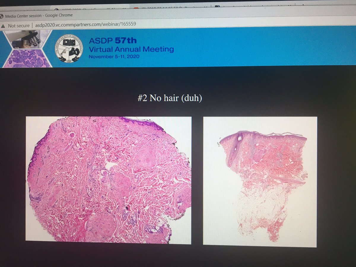 tonitatirado's tweet image. #dermpath #ASDP20 How to know you have a cicatricial alopecia 2