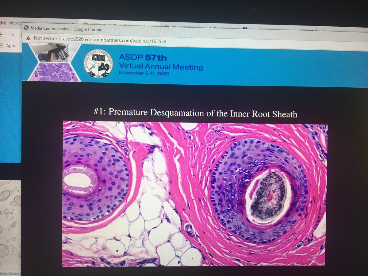 tonitatirado's tweet image. #dermpath #ASDP20 How to know you have a cicatricial alopecia 2