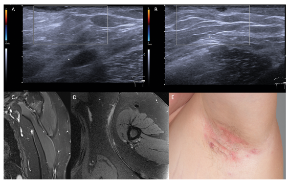actadv's tweet photo. A new paper:
Non-contrast-enhanced 3-Tesla Magnetic Resonance Imaging Using Surface-coil and Sonography for Assessment of Hidradenitis Suppurativa Lesions
#3Tesla #hidradenitissuppurativa #MRI #sonography #surfacecoil #treatment
https://t.co/wWxHeFGjKv https://t.co/9wuqi3UKgf