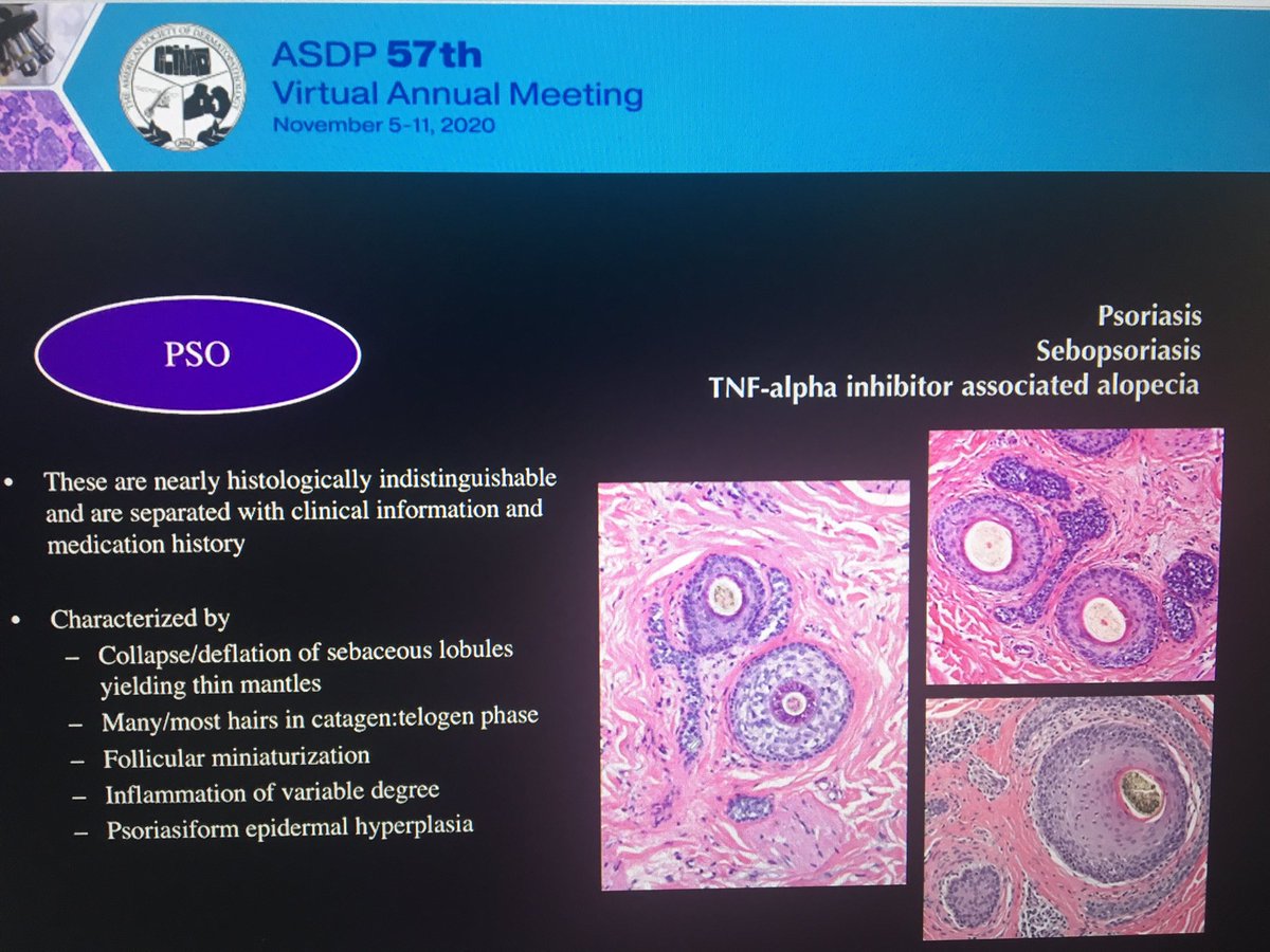 tonitatirado's tweet image. #dermpath #ASDP20 Psoriasiform pattern. Histologically indistinguishable! May be the first presentation in psoriasis and there might not be known history Dr. Cowper