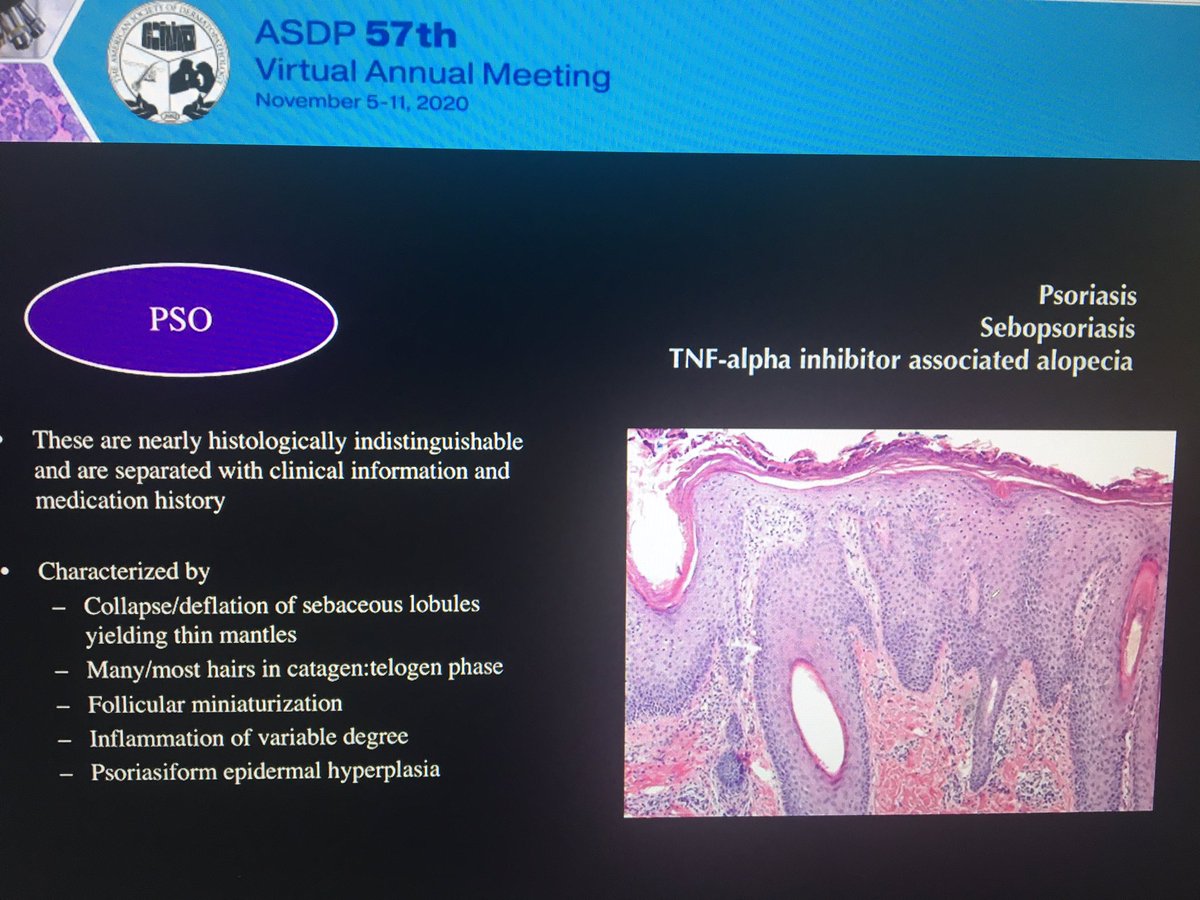 tonitatirado's tweet image. #dermpath #ASDP20 Psoriasiform pattern. Histologically indistinguishable! May be the first presentation in psoriasis and there might not be known history Dr. Cowper
