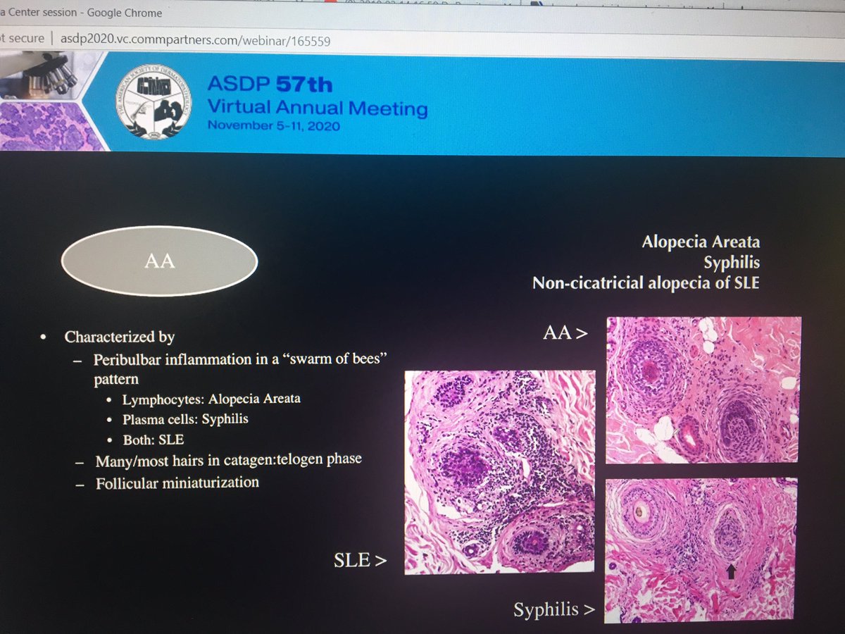 tonitatirado's tweet image. #ASDP20 #dermpath All these May show swarm of bees 🐝 AA SLE Syphilis