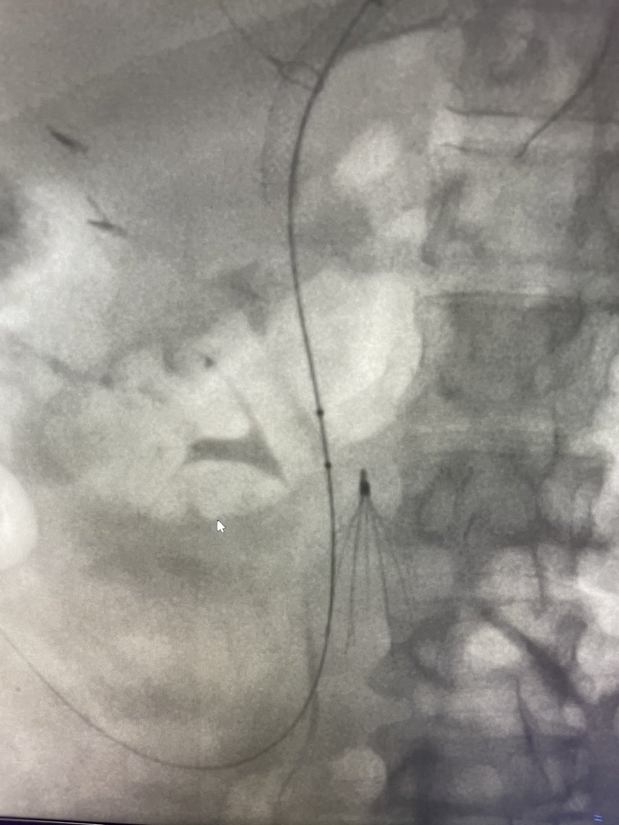 ajkubs's tweet photo. Acute on chronic portal/SMV/splenic vein thrombosis with variceal bleed. Perc pharmocomechanical thrombectomy then “gunsite” DIPS @AbhiKumar47 @prat_shuk @RutgersIR @SIRspecialists #irad #angiojet #dips #justsnareit https://t.co/t1Phgx7jHq