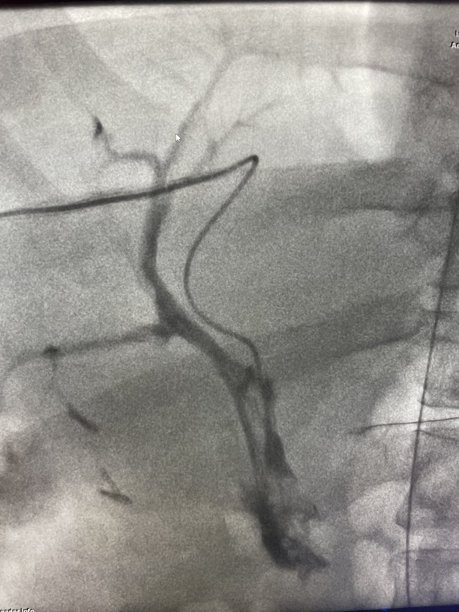ajkubs's tweet photo. Acute on chronic portal/SMV/splenic vein thrombosis with variceal bleed. Perc pharmocomechanical thrombectomy then “gunsite” DIPS @AbhiKumar47 @prat_shuk @RutgersIR @SIRspecialists #irad #angiojet #dips #justsnareit https://t.co/t1Phgx7jHq