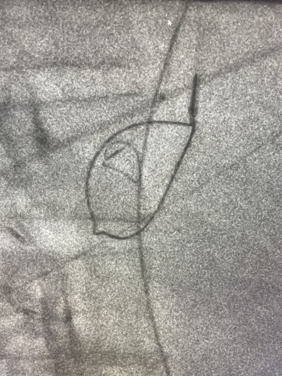 ajkubs's tweet photo. Acute on chronic portal/SMV/splenic vein thrombosis with variceal bleed. Perc pharmocomechanical thrombectomy then “gunsite” DIPS @AbhiKumar47 @prat_shuk @RutgersIR @SIRspecialists #irad #angiojet #dips #justsnareit https://t.co/t1Phgx7jHq