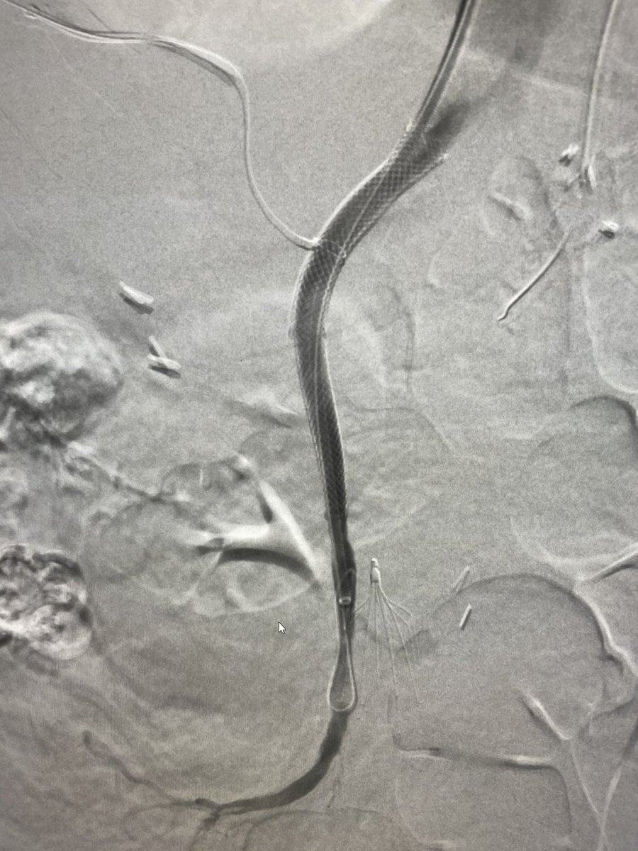 ajkubs's tweet photo. Acute on chronic portal/SMV/splenic vein thrombosis with variceal bleed. Perc pharmocomechanical thrombectomy then “gunsite” DIPS @AbhiKumar47 @prat_shuk @RutgersIR @SIRspecialists #irad #angiojet #dips #justsnareit https://t.co/t1Phgx7jHq